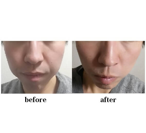 顔痩せダイエット１週間の驚きのビフォーアフター公開します
